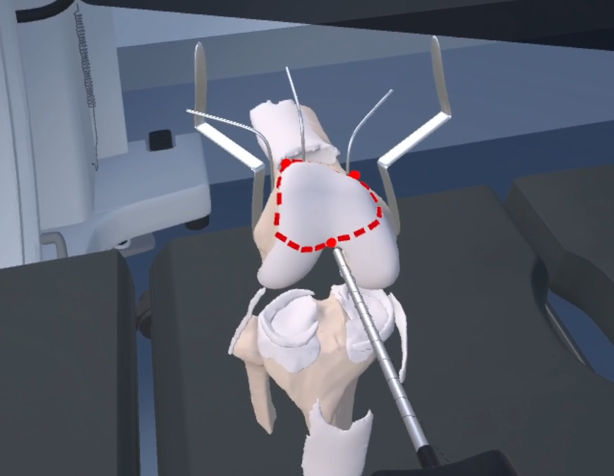 VR knee surgery simulation screenshot showing surgical tools and a highlighted incision path.